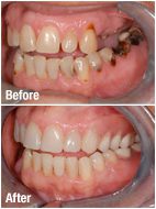 Before and after dental crowns