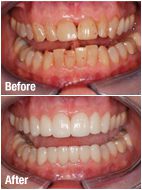 Dental Crown Before and After Photos
