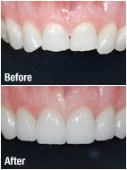 Before and after dental crowns