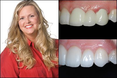 Discolored Tooth Filling  Annapolis Specialist for Restoring Your