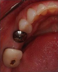 Implant Dentist Annapolis