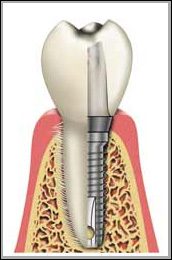 Dental Implants