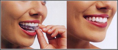 Invisalign treatment in Annapolis, Maryland