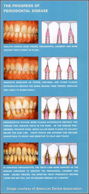 mild periodontitis