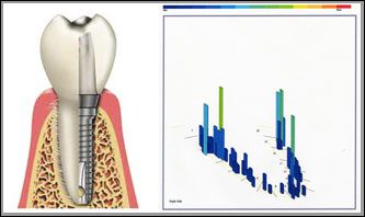 Jaw and Gum Resorption, Annapolis Specialist for Restoring Your Oral  Health