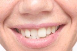 aligning crooked teeth in Annapolis Maryland