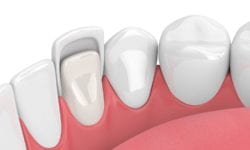 Transform Your Smile With Porcelain Veneers