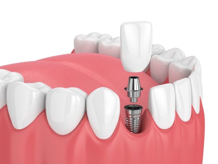 dental implant dentist in annapolis