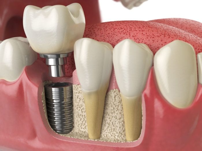 Benefits of Dental Implants Annapolis, MD