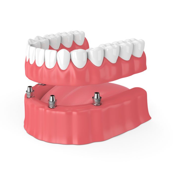 Multiple Dental Implants for a permanent denture