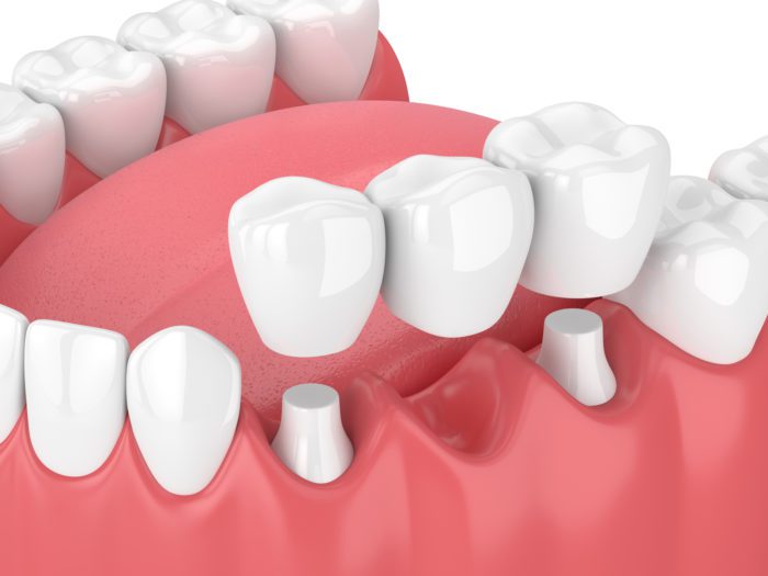 Dental Bridges Annapolis MD