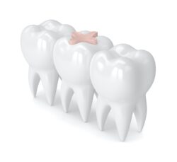 composite resin dental filling