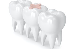 composite resin dental filling